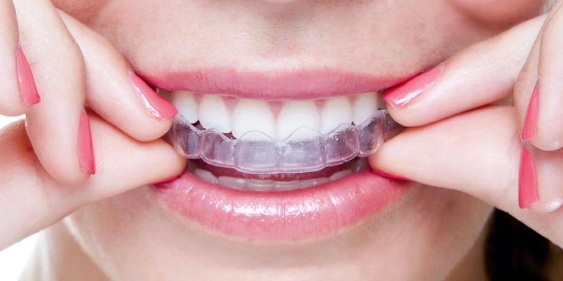 Hiel Vertrek naar Minimaliseren Onzichtbare beugels (Airsmile) | Dental Care Alkmaar
